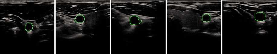 Carotid